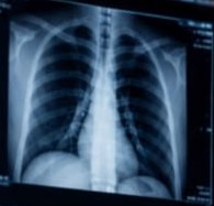 Radiografia de tórax
